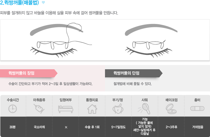 2.퀵쌍꺼풀(매몰법)