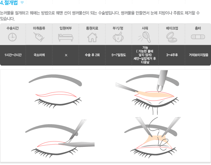 4.절개법